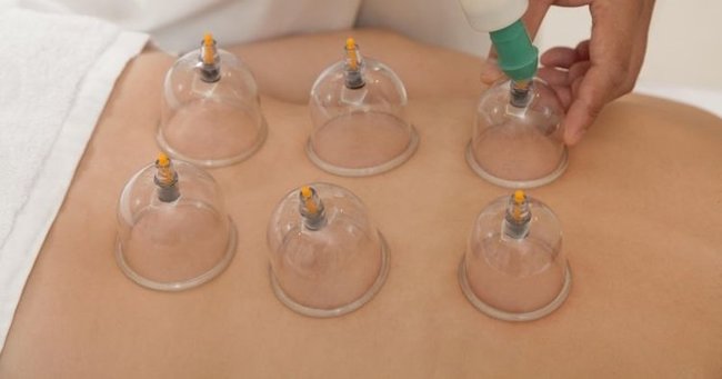 Hacamatın faydaları nelerdir? Hacamat nasıl yapılır?