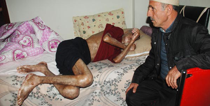 İlik Nakli Sonrası Vücudunda Yaralar Çıktı, Gözlerini Kaybetti