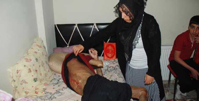 İlik Nakli Sonrası Vücudunda Yaralar Çıktı, Gözlerini Kaybetti