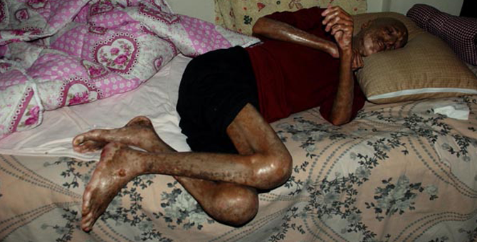 İlik Nakli Sonrası Vücudunda Yaralar Çıktı, Gözlerini Kaybetti