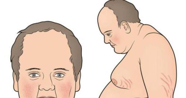 Cushing sendromu nedir? Cushing belirtileri nelerdir?