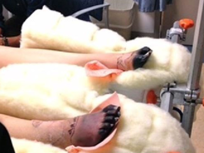 Lauren Wasser Kimdir | Toksik Şok Sendromu Nedir