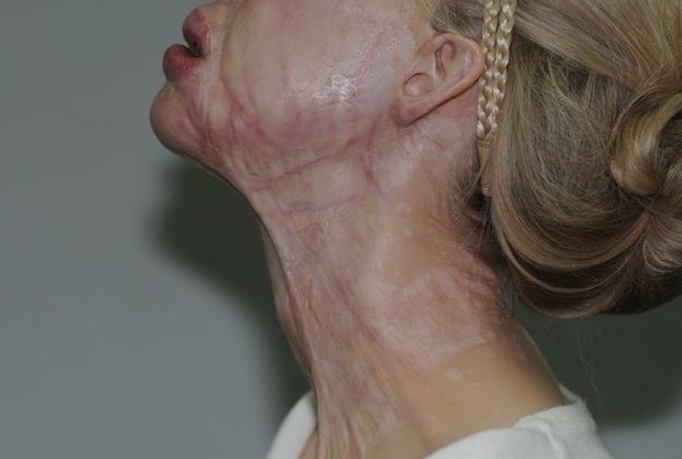 Eski sevgilisi tecavüz edip yüzüne asit fırlattı!