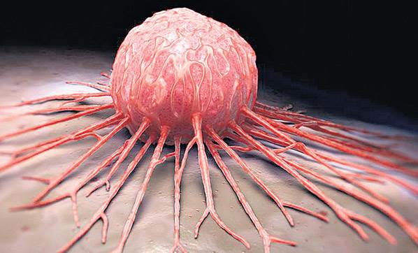 Kanser belirtileri nelerdir? Kanserin nedenleri nelerdir? Tüm tedavi yöntemleri