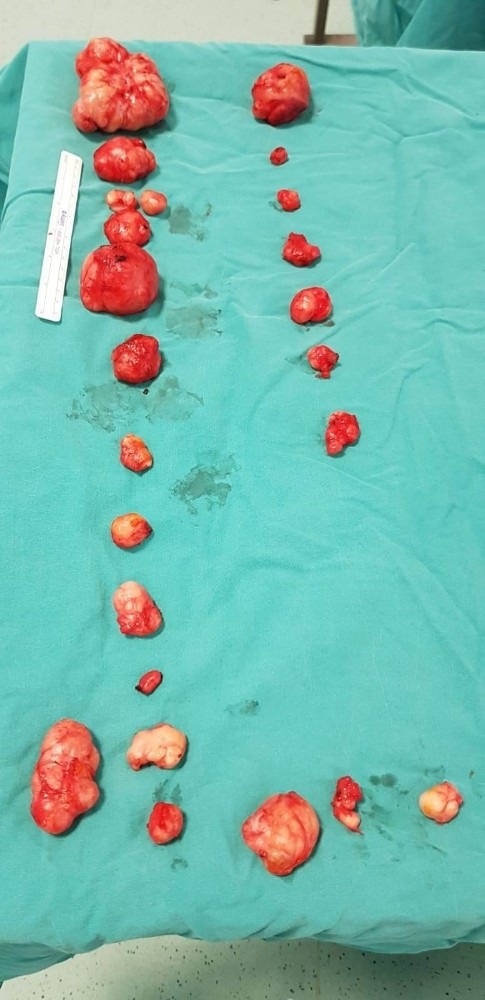 Genç kadından 24 adet kitle çıkartıldı