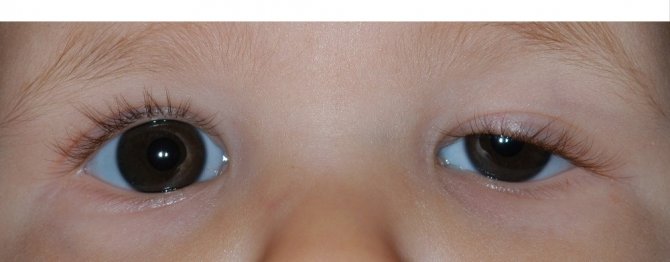 Uzmanı Doç.Dr.Barış Yeniad: Çocuklarda göz kapağı düşüklüğü önemsenmeli