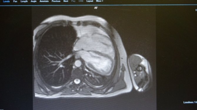 45 yaşındaki erkek hastanın Doğuştan kalp zarının bulunmadığı ortaya çıktı