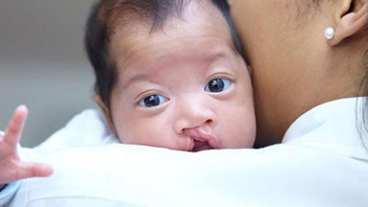 Nager sendromu nedir? Sebepleri nedir? Nager sendromu nasıl anlaşılır?