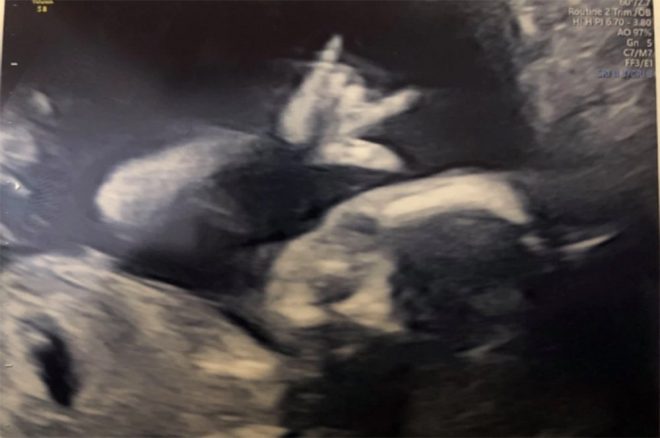 Bebeklerinin cinsiyetini öğrenmek isteyen çift şok bir manzara ile karşılaştı!