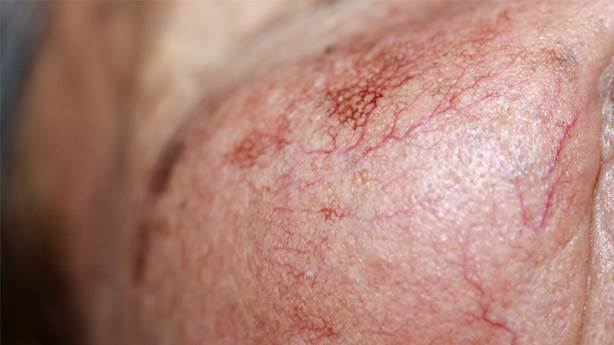  kaçış sendromu hastalığı | kaçış sendromu | Kaçış sendromu nedir? | Kaçış sendromu belirtileri | Kaçış sendromu tedavisi