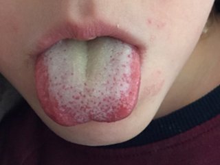 Peki paslı dil neden olur? Paslı dil hangi hastalıkların belirtisi?