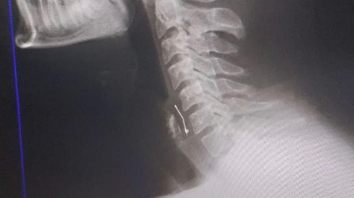 Yediği pastanın içinden iğne çıktı! Boğazına saplandı