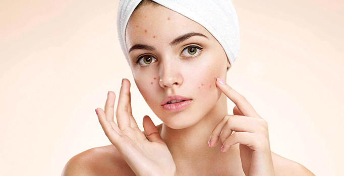 Sivilce nedir? Nasıl geçer? Hangi besinler iyi gelir? İzleri nasıl geçer?