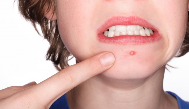 Sivilce nedir? Nasıl geçer? Hangi besinler iyi gelir? İzleri nasıl geçer?