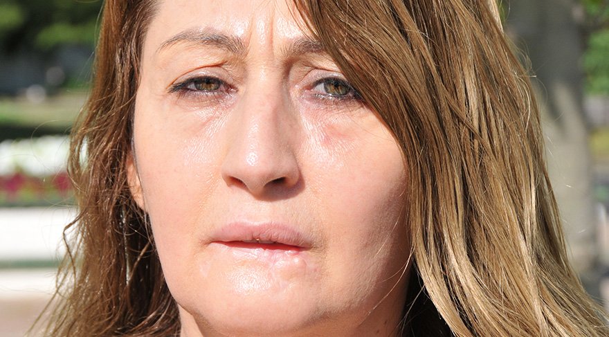 Dudağına dolgu yaptırmış, alt dudağını kaybetmişti! Artık yemek yiyebiliyor