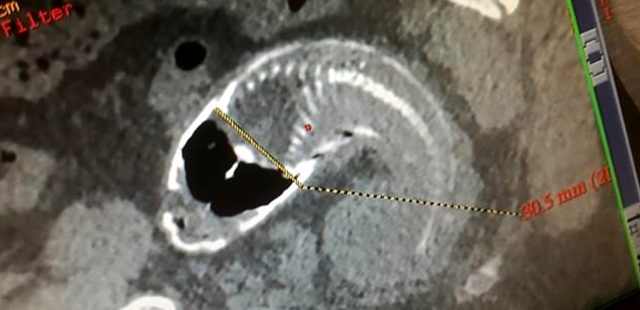 Çin'de akıl almaz olay! 40 santimlik balık, 30 yaşındaki adamın makatına kaçtı