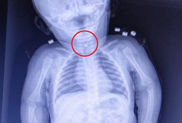 Tekirdağ'da korkunç olay! 7 aylık bebeğin yemek borusundan çengelli iğne çıktı