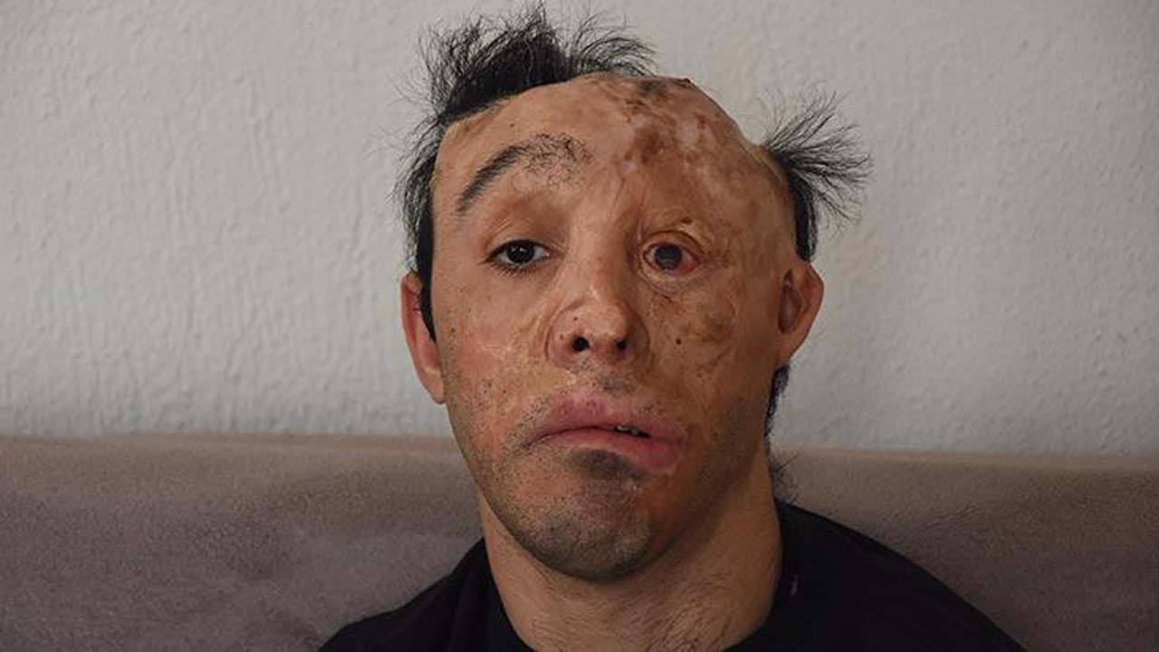 Ameliyatına virüs engeli! "Hayalleri yıkıldı"