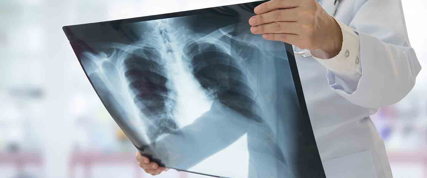 Pnömoni nedir? Ne demek? Belirtileri neler? Çeşitleri? 