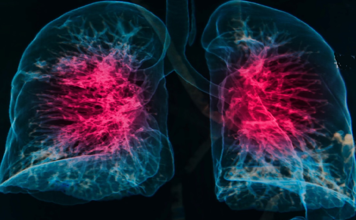 Pnömoni nedir? Ne demek? Belirtileri neler? Çeşitleri? 