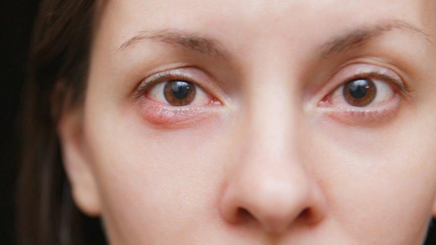 Göz uçuğu rahatsızlıklarına dikkat!