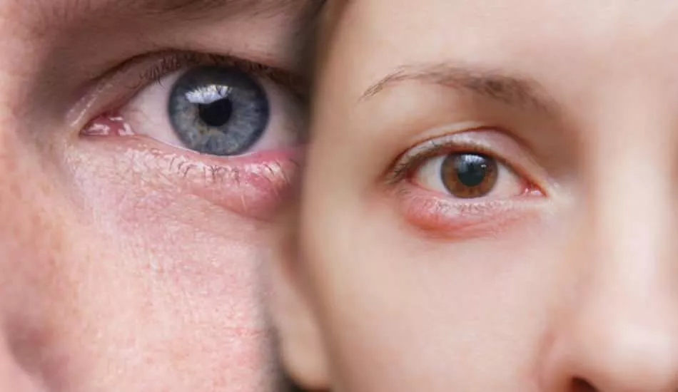 Göz uçuğu rahatsızlıklarına dikkat!