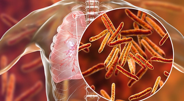 Tüberküloz hastalığı nasıl bulaşır? Tedavisi nedir? 