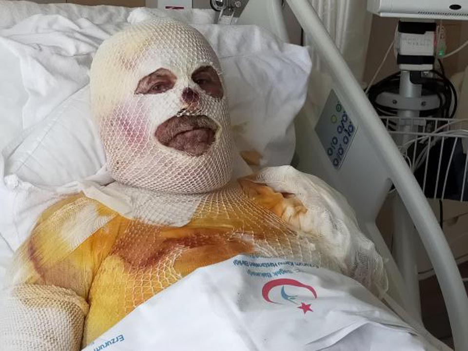 Sobayı benzinle yakmak isteyen adam feci şekilde yandı