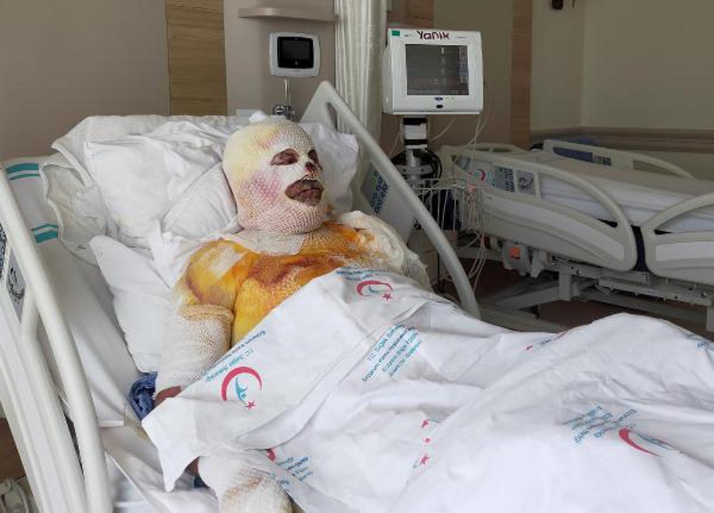 Sobayı benzinle yakmak isteyen adam feci şekilde yandı