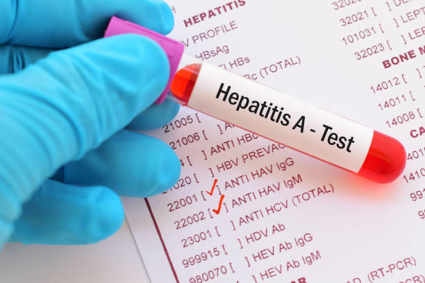 Hepatit A Nedir, Belirtileri Nelerdir? Hepatit A nasıl bulaşır?