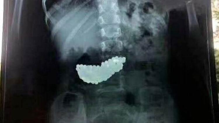 7 yaşındaki çocuğun boğazından 18 cm’lik kalem çıktı