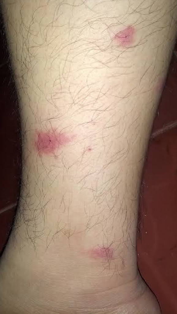 Asya Kaplanı sivrisineği nedir? Nasıl kurtulunur? Nasıl öldürülür? Isırığına ne iyi gelir?