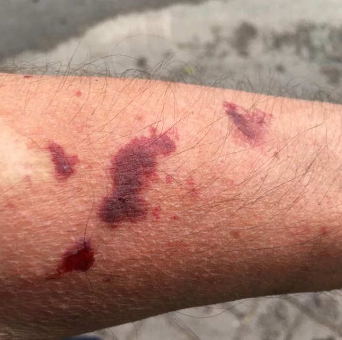 Asya Kaplanı sivrisineği 