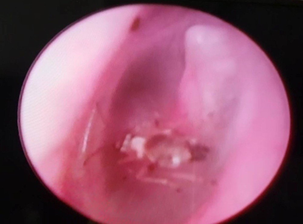 İşitme sorunu yaşayan kişinin kulağından canlı sinek çıkarıldı