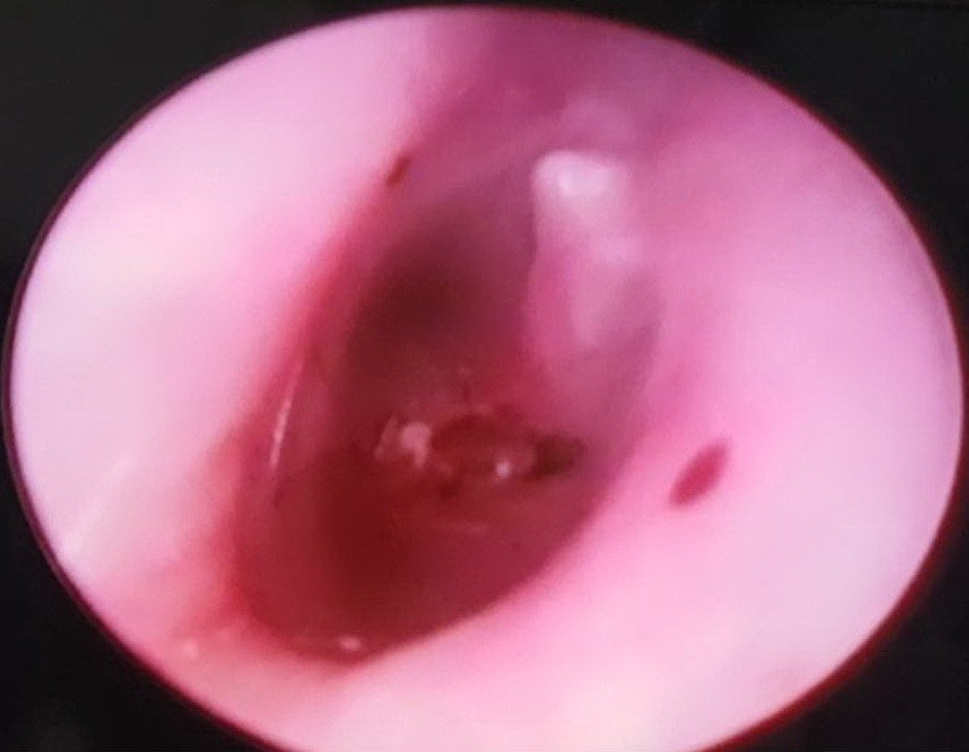 İşitme sorunu yaşayan kişinin kulağından canlı sinek çıkarıldı