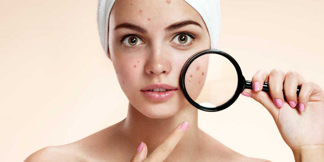 Sivilce nedir? Neden olur? Doğal yöntemlerle nasıl geçer? Sivilce izleri nasıl geçer?