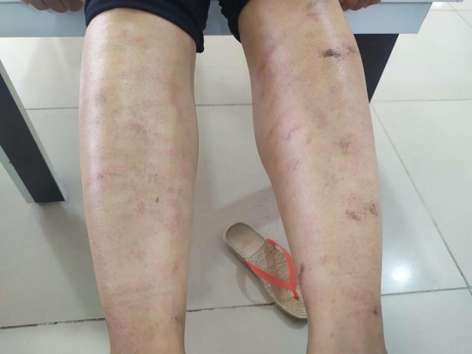 Lazer yaptırmak isteyen kadının vücudu yandı