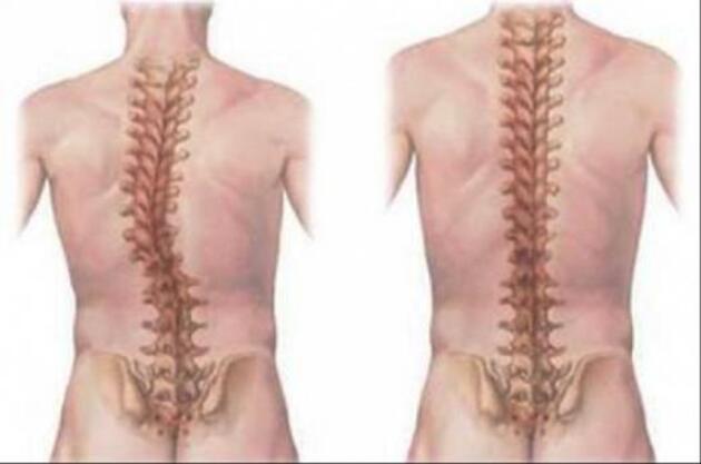 Skolyoz nedir, tedavisi var mı? Skolyoz nasıl önlenir? 