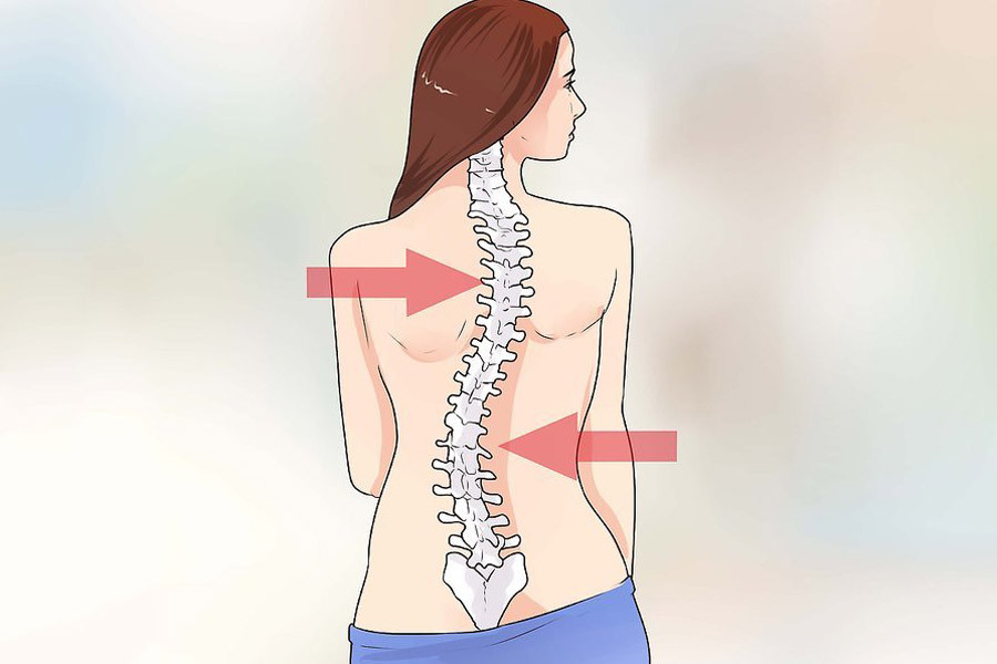 Skolyoz nedir, tedavisi var mı? Skolyoz nasıl önlenir? 