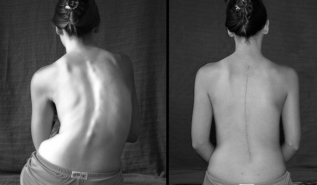 Skolyoz normal doğuma engel mi? Skolyoz hastaları normal doğum yapabilir mi?