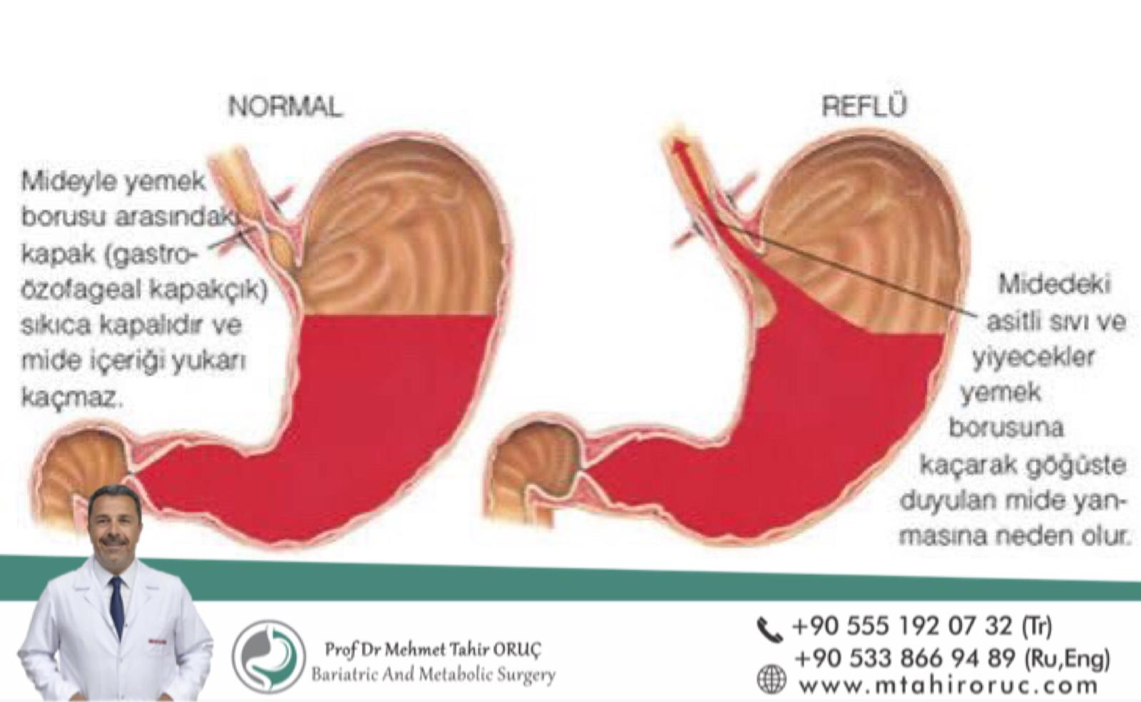 Reflü Nasıl Engellenir? Reflüde ne yenir?