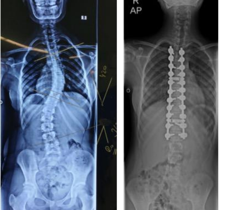 Skolyoz normal doğuma engel mi? Skolyoz hastaları normal doğum yapabilir mi?
