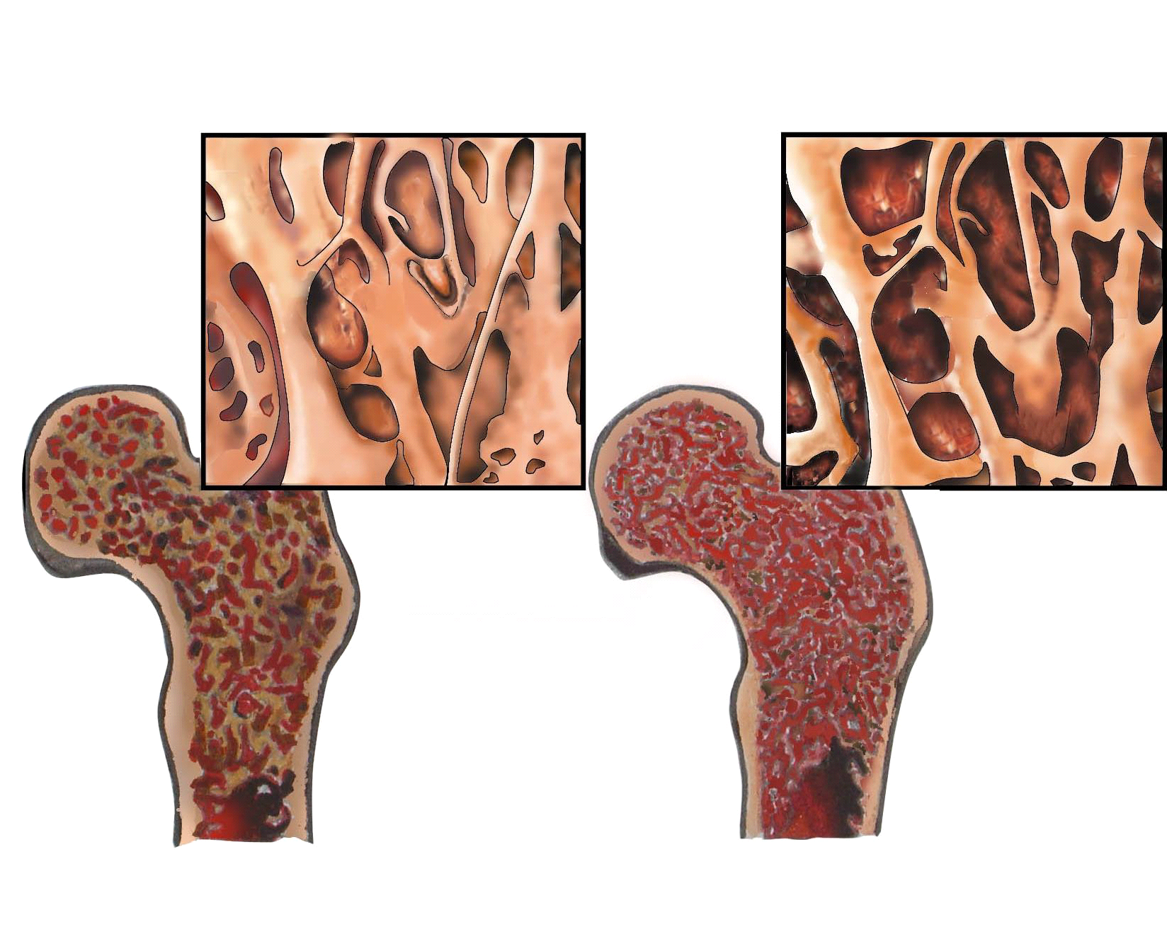 Osteoporoz (Kemik Erimesi) nedir? Osteoporoz Belirtileri nelerdir?