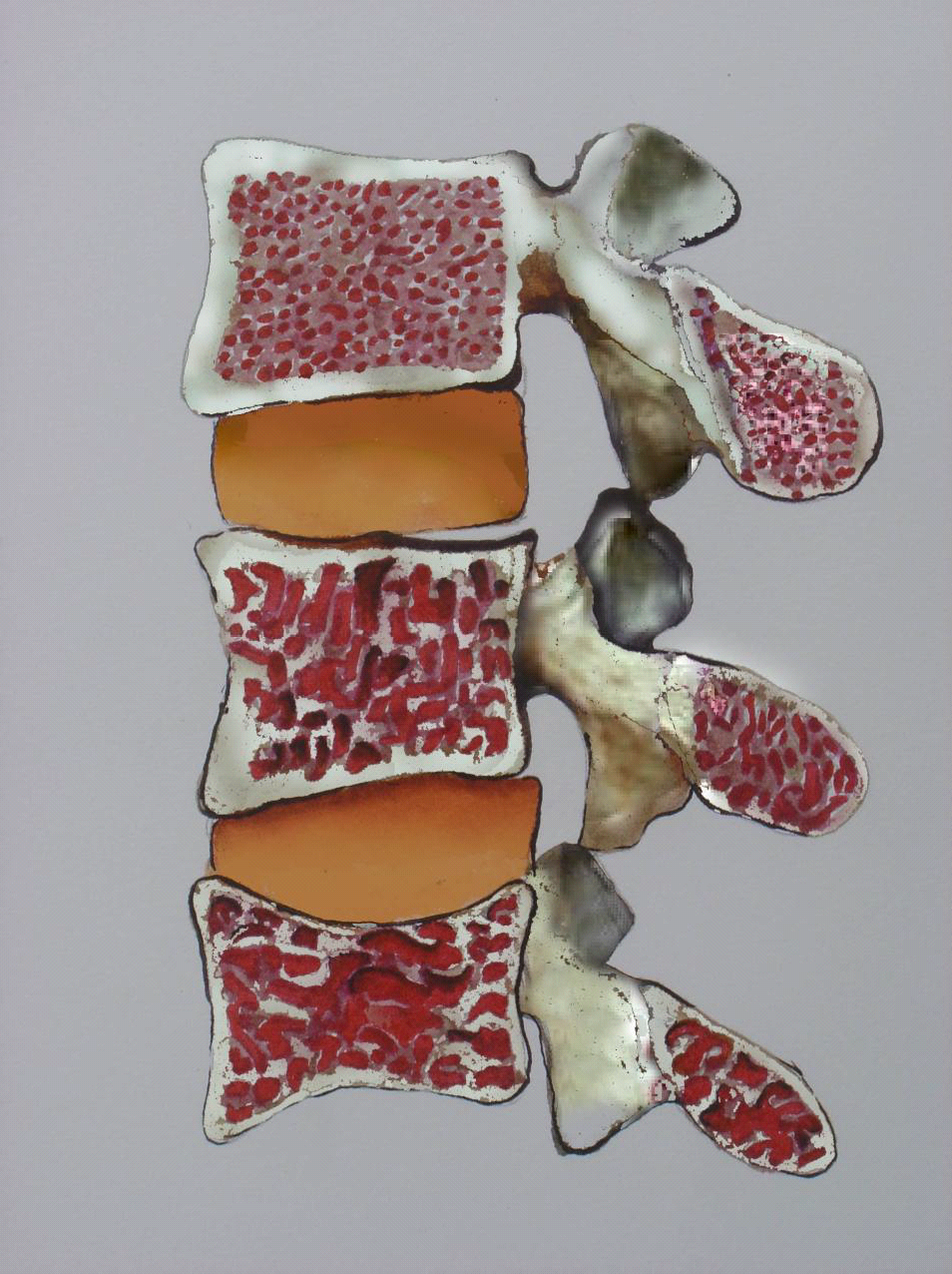 Osteoporoz (Kemik Erimesi) nedir? Osteoporoz Belirtileri nelerdir?