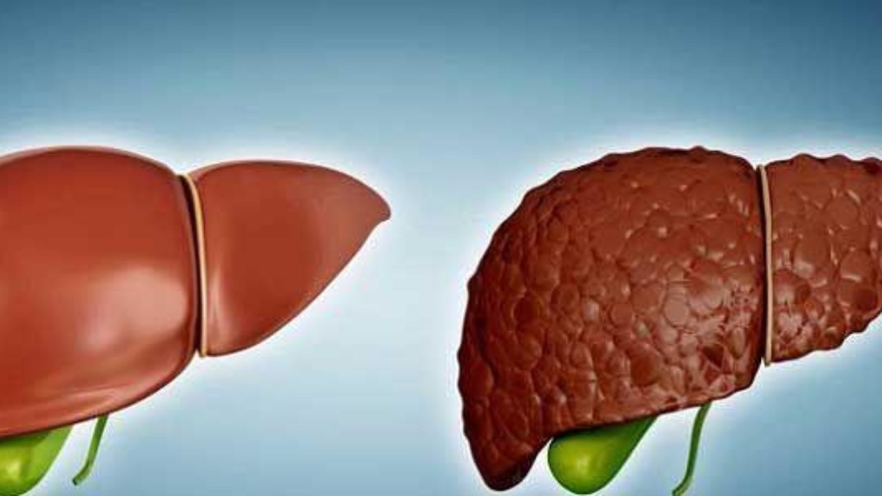 Siroz hastalığı nedir? Neden olur? | Siroz belirtileri, tedavisi, evreleri ve çeşitleri