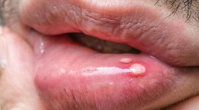 AIDS Hastalığı Nedir? Aids Belirtileri Nelerdir, Nasıl Bulaşır?