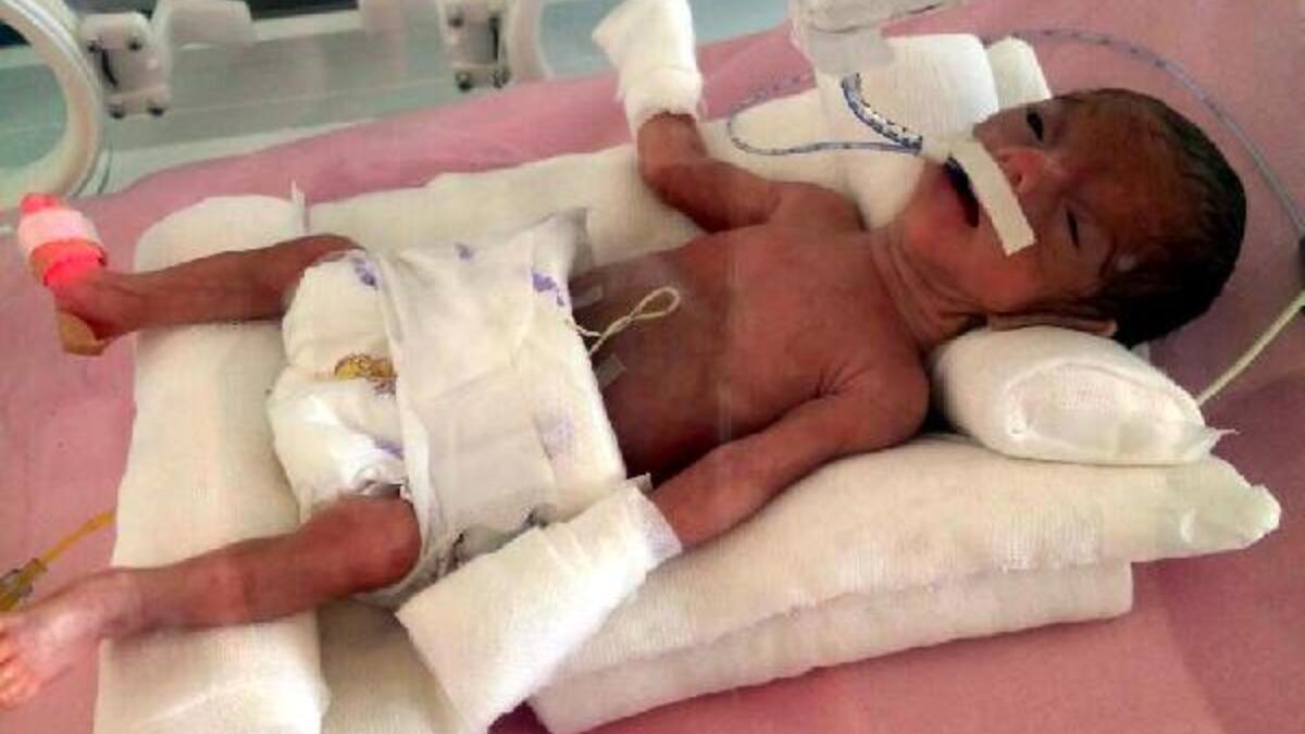 Prematüre bebek nedir? Prematüreye ne sebep olur? Prematüre bebeklerde görülen sorunlar?