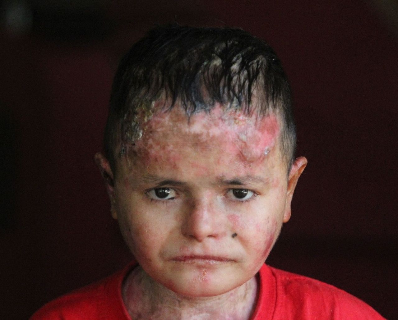 Kelebek hastalığı nedir, neden olur, nasıl olur? Kelebek hastalığı bulaşıcı mı, geçer mi?