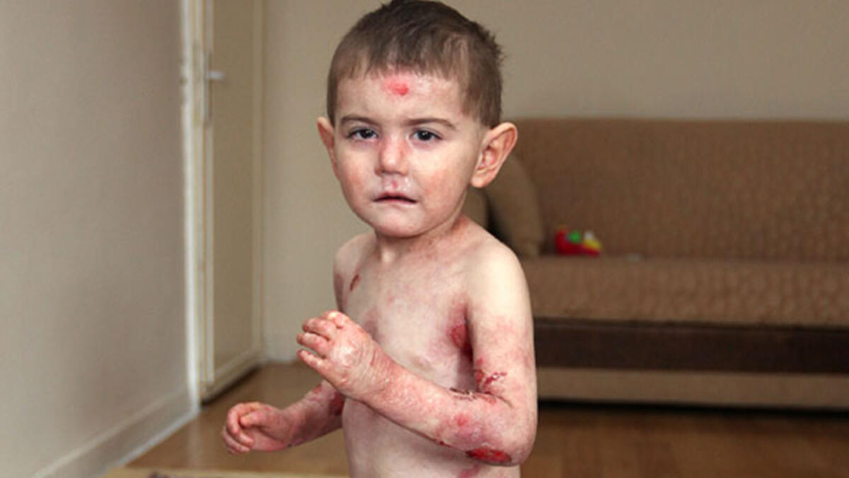 Kelebek hastalığı nedir, neden olur, nasıl olur? Kelebek hastalığı bulaşıcı mı, geçer mi?