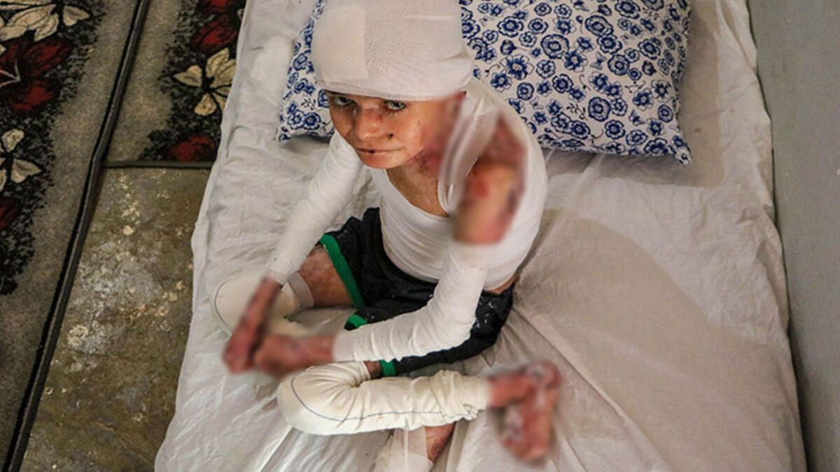 Kelebek hastalığı nedir, neden olur, nasıl olur? Kelebek hastalığı bulaşıcı mı, geçer mi?